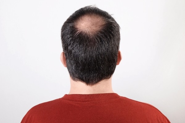 image depicting male pattern baldness